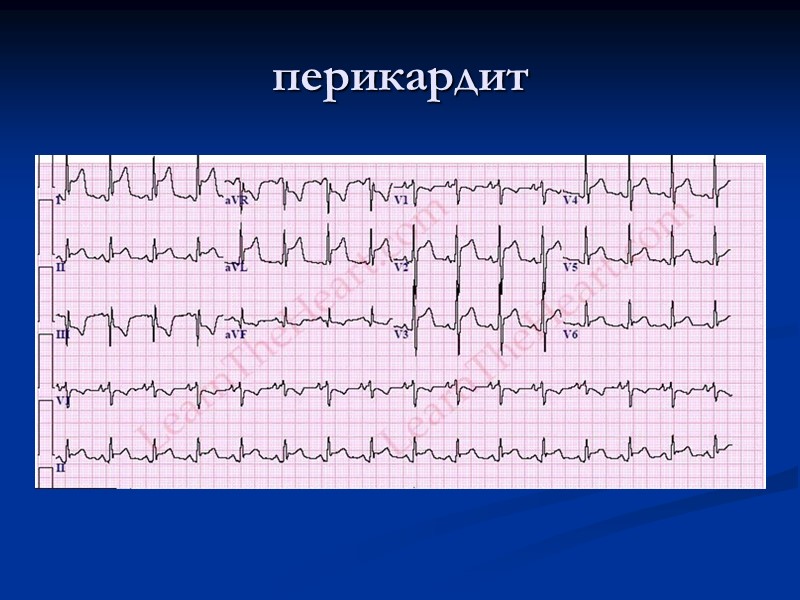 перикардит